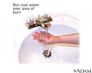 First aid for burns